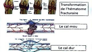 Les pseudarthroses suppurées de la diaphyse fémorale [upl. by Gensler]