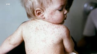 Your child has a viral rash but which one is it Here’s a comparison [upl. by Newel]