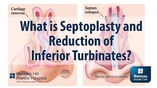 What is Septoplasty and reduction of Inferior Turbinates [upl. by Madson]