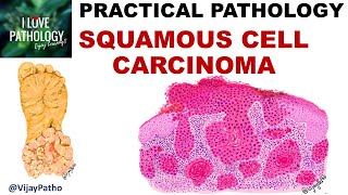 SQUAMOUS CELL CARCINOMA Clinical features amp Morphology Premalignant lesions [upl. by Enovad]