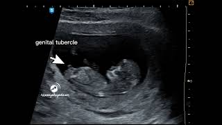 Fetal gender at 11 Weeks [upl. by Neuberger]