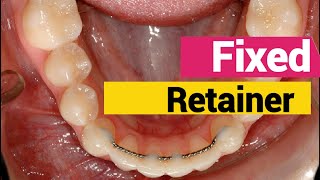 Bonding fixed permanent retainer in orthodontics [upl. by Sumerlin]