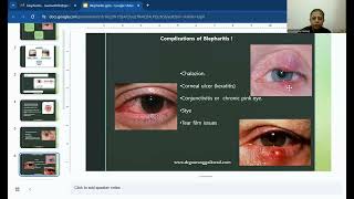 Homeopathy For Blepharitis [upl. by Eneleoj108]