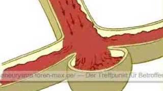 Die Entstehung eines AneurysmasHirnaneurysmas [upl. by Yarvis705]