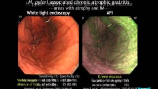 Advanced Imaging in the Diagnosis of Gastric Intestinal Metaplasia The Experts Approach [upl. by Esra]