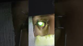 cxl treatment for keratoconus [upl. by Jareen]