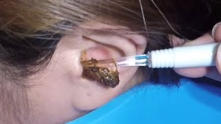 The Most Massive Earwax Removed in One Scoop [upl. by Haim]