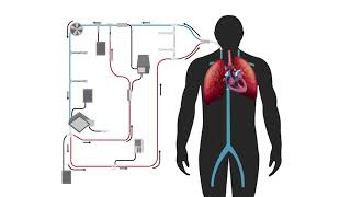 Modified Thermodilution in Extracorporeal Therapy [upl. by Linehan]