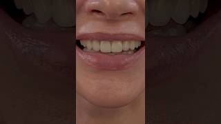 10 Porcelain Veneers veneers smilemakeover dentist [upl. by Analli]