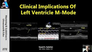 Clinical Implications of LV mmode [upl. by Beaston461]