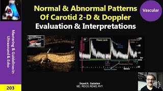 Normal amp Abnormal Patterns of Carotid Doppler [upl. by Rehpotsirahc]