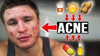 Does THIS Cause Acne  Diet Sodas Sun Nuts amp More EP 3 [upl. by Alusru]