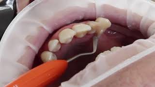 Composite rest seat additions onto palatal surfaces of maxillary anterior teeth [upl. by Atived739]