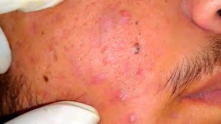 sac be spa blackheads elderly 2024  sac be spa old age blackheads 2024  sac be spa thuy 777 [upl. by Enovaj]