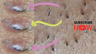 Ingrown hair  thick facial hair extraction [upl. by Hescock732]