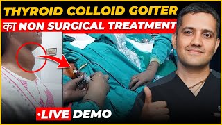 Thyroid Colloid Cyst  Experience of Treating Big Swelling Neck  Dr Gaurav Gangwani IR [upl. by Isabelle44]