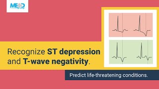 Simplifying ST depression and Twave negativity [upl. by Etnaled835]