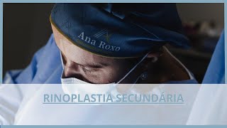 RINOPLASTIA SECUNDÁRIA [upl. by Liliane]