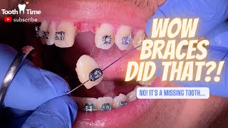 Braces with a missing tooth  video 3  Tooth Time Family Dentistry New Braunfels Texas [upl. by Eahsan]