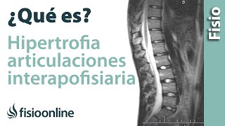 Hipertrofia de las articulaciones interapofisarias o facetarias  ¿Qué es [upl. by Ahsinauq]