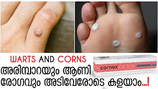 Successful Treatment for Hard Warts and Corns  അരിമ്പാറയും ആണിരോഗവും അടിവേരോടെ കളയാം  CORNEX GEL [upl. by Bride159]