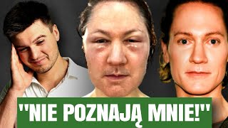 Miliony Na Odmłodzenie Aby Zdegenerować Twarz… [upl. by Tacita881]