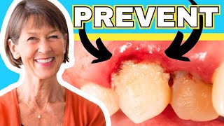 How To Treat Gingivitis And Gum Recession At Home [upl. by Asilla929]