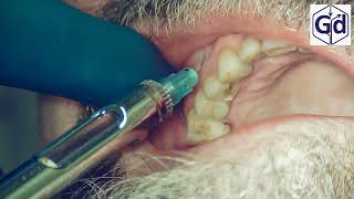 Infiltration Anesthesia for treatment tooth 24 [upl. by Huoh]