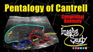 Pentalogy of Cantrell  Gastroschisis  Ectopia Cordis  Ultrasound  Anomaly  Case 289 [upl. by Nels]