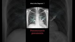 Pneumocystis pneumonia 113 chest Xray Quiz pulmonary disease radiologychannel007 [upl. by Artaed]