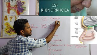 CSF RHINORRHEA  ENTNOSE [upl. by Siusan]