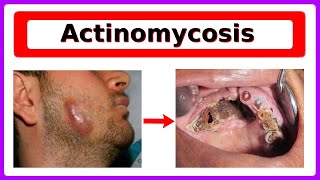 actinomycosis [upl. by Ennovehs]