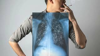 Common Questions About Mesothelioma Treatment [upl. by Anisah78]