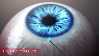 Ophthalmology glaucoma IOP drainage animation [upl. by Ainud913]