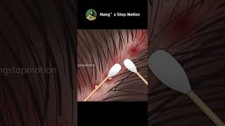 ASMR Itchy scalp and head acne Stressrelieving scalp treatment [upl. by Grantham112]