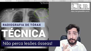 Assista a este vídeo e nunca mais perca uma Fratura na Radiografia de Tórax  Galvani Filho [upl. by Nilak917]