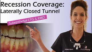 Recession Coverage Laterally Closed Tunnel wtih Subepithelial CTG EMD [upl. by Ardnua]