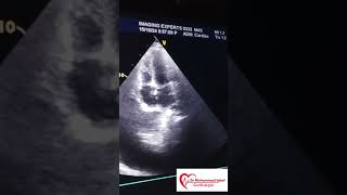 Constrictive pericarditis Echo  CP Echo  Echocardiography toacs  constrictive pericarditis [upl. by Yendroc]