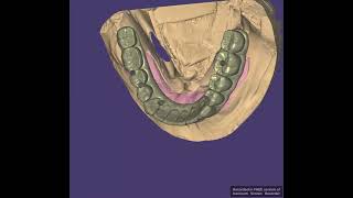 Lower implant crown bridge [upl. by Vitek]