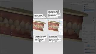 Medit  Ortho Simulation V 130 digitaldentistry dentist medit intraoralscan [upl. by Cottrell]