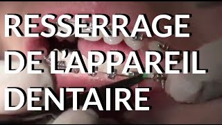 Resserrage de lappareil dentaire  Appareildentaireinfo [upl. by Chee]