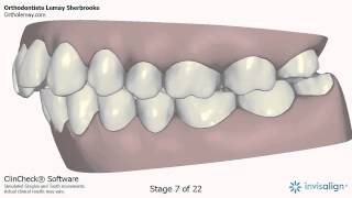 Invisalign Clincheck adulte Orthodontiste Lemay Sherbrooke NM48 143234 [upl. by Tsirc]