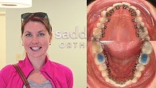 Incognito Hidden Lingual Braces  A Patients Experience [upl. by Michey]