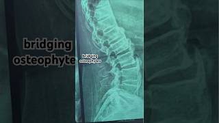 Ankylosing spondylitisBechtrewe’s diseaseAxial Spondyloarthritis xray video ultraradiology [upl. by Atikat837]