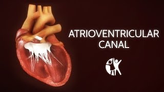 Atrioventricular Septal Defect  AV Canal [upl. by Nanreit419]