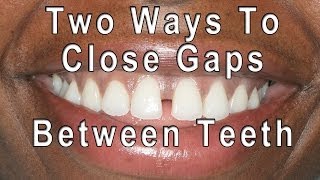 How to Close Gaps Between Teeth [upl. by Enitsenre]