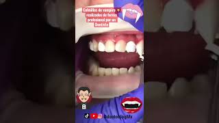 Colmillos de vampiro 🧛‍♂️ realizados por un Dentista 🦷 😷 shorts colmillos vampire vampiro [upl. by Etnoled]