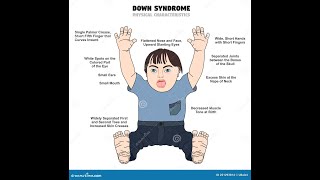 MEOTIC ERRORS  NON DISJUNCTION OF CHROMOSOMES  DOWN SYNDROME  KLINEFILTER SYNDROME  TURNER SYNDR [upl. by Oranneg]