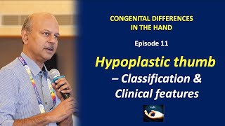 Congenital hand Episode 11  Hypoplastic Thumb  Classification and Clinical features [upl. by Gloriana]