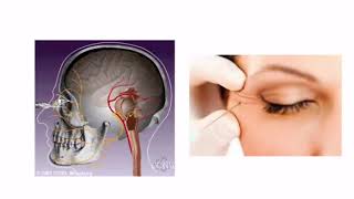 Hemifacial Spasm with Dr Dong Kim [upl. by Dominga808]